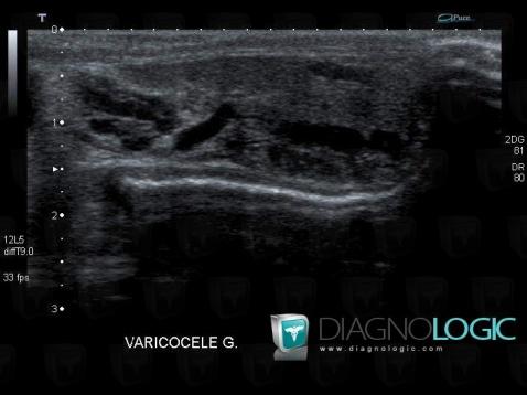 Radiology case : Varicocele (US) - Diagnologic