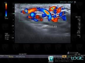 Varicocele, Scrotum, US