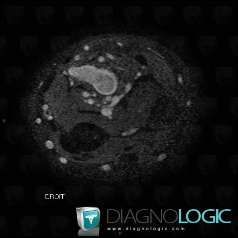 Vascular malformation, Other soft tissues/nerves - Forearm, MRI