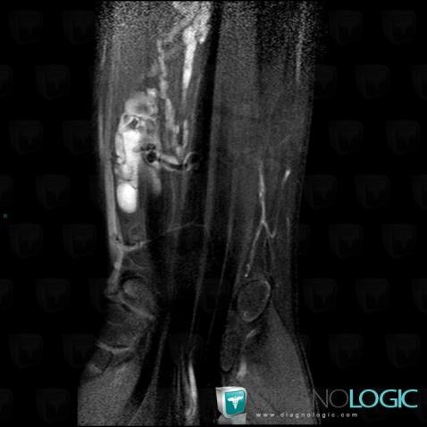 Vascular malformation, Other soft tissues/nerves - Forearm, MRI