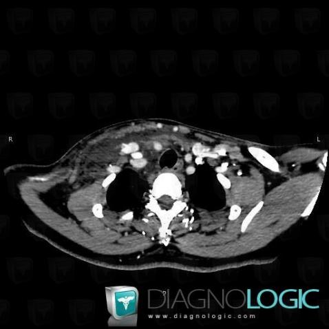 Vascular rupture, Internal jugular vein, CT