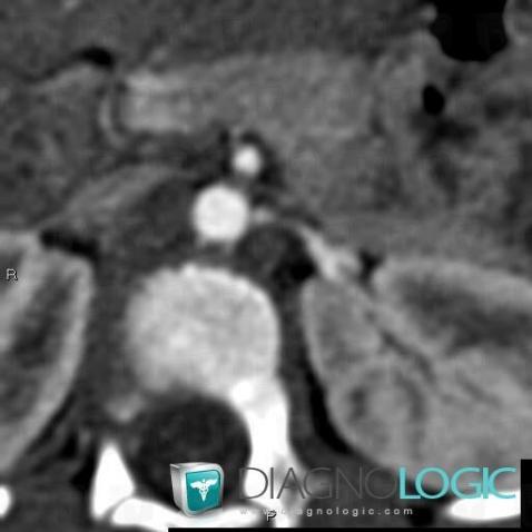 Vascular stenosis, Abdominal aorta branches, CT