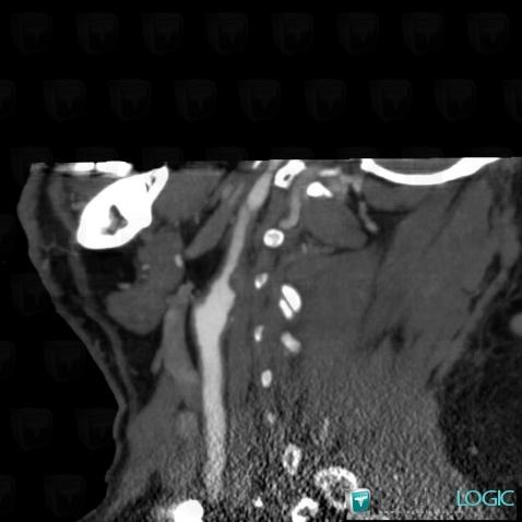 Vascular stenosis, Internal carotid artery, CT