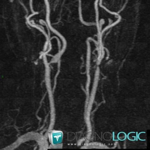 Vascular stenosis, Internal carotid artery, MRI