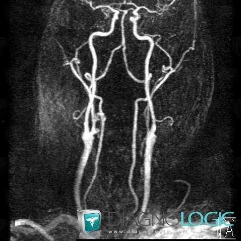 Vascular stenosis, Internal carotid artery, MRI