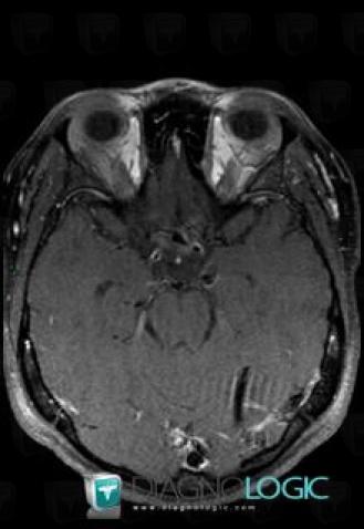 Vasculitis, Cerebral arteries, MRI