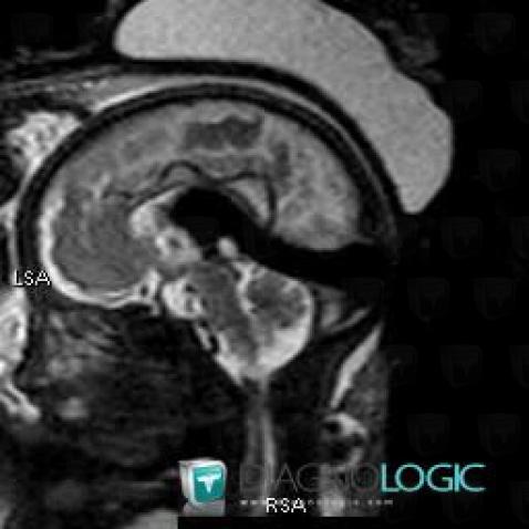 Vein-Galen arteriovenous malformation, Cerebral falx / Midline, Cerebral veins, MRI