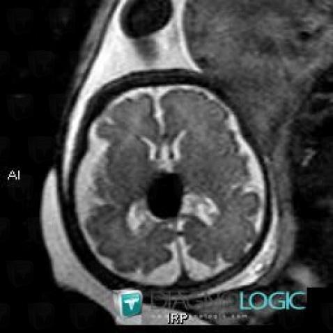 Vein-Galen arteriovenous malformation, Cerebral hemispheres, Pineal region, MRI