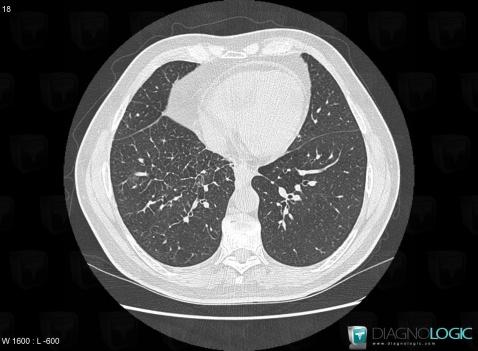 Venous compression, Pulmonary parenchyma, CT