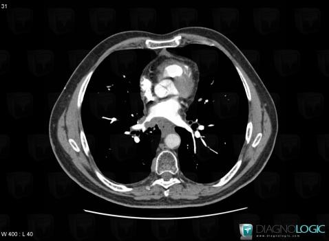 Venous compression, Veins - Thorax, CT