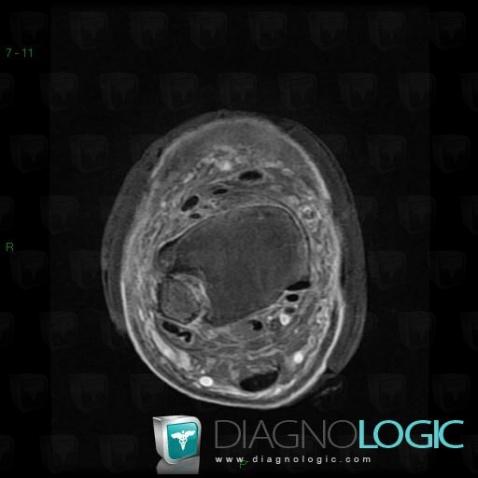 Venous insufficiency, Other soft tissues/nerves - Leg, MRI