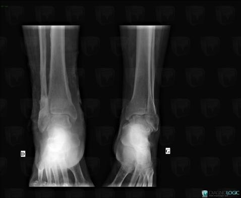 Venous insufficiency, Tibia - Distal part, Fibula - Distal part, X rays