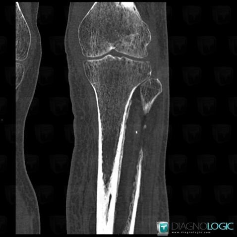Venous insufficiency, Tibia - Mid part, CT