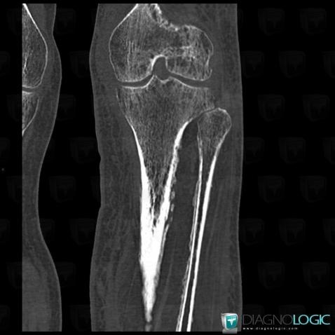 Venous insufficiency, Tibia - Proximal part, Fibula - Proximal part, CT