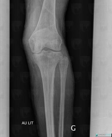 Venous insufficiency, Tibia - Proximal part, Fibula - Proximal part, X rays