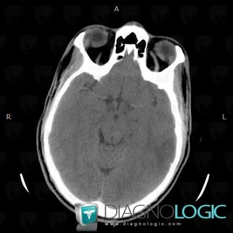 Venous sinus thrombosis, Cerebral hemispheres, CT