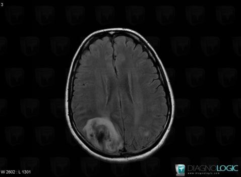 Venous sinus thrombosis, Cerebral hemispheres, MRI