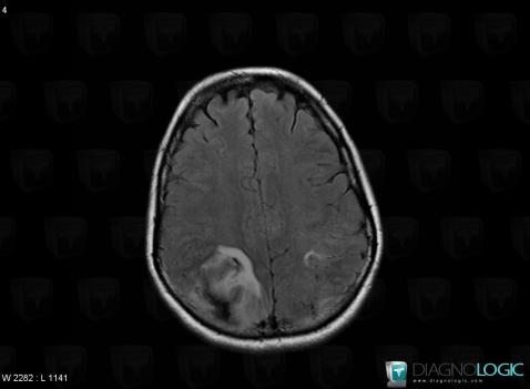 Venous sinus thrombosis, Cerebral hemispheres, MRI