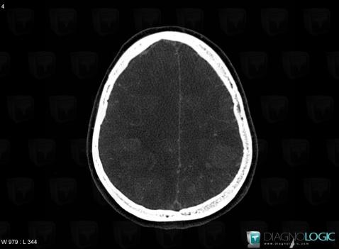 Venous sinus thrombosis, Cerebral veins, CT