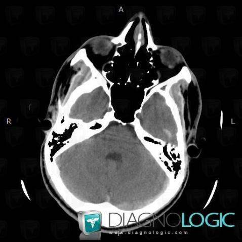 Venous sinus thrombosis, Cerebral veins, CT