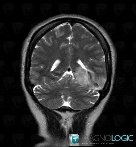 Venous sinus thrombosis, Cerebral veins, MRI