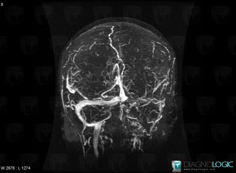 Venous sinus thrombosis, Cerebral veins, MRI