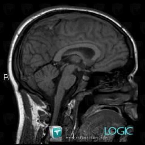 Venous sinus thrombosis, Cerebral veins, MRI