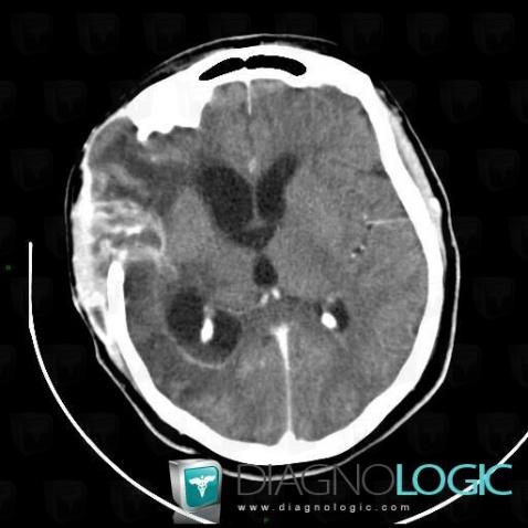 Ventriculitis, Ventricles / Periventricular region, CT