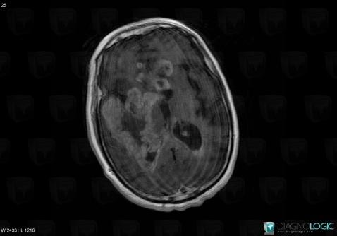 Ventriculitis, Ventricles / Periventricular region, MRI