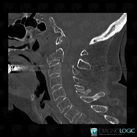 Vertebral fracture, Vertebral body / Disk, CT