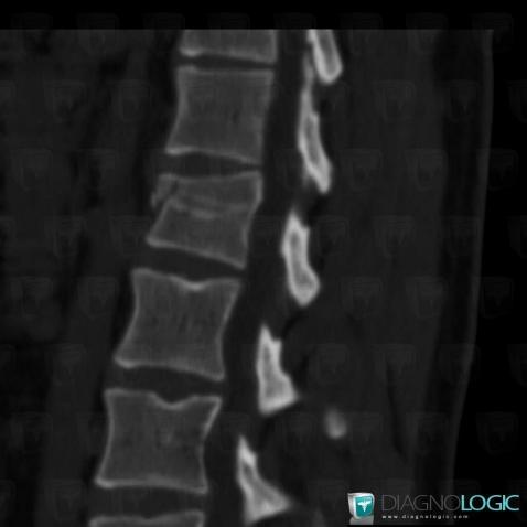 Vertebral fracture, Vertebral body / Disk, CT