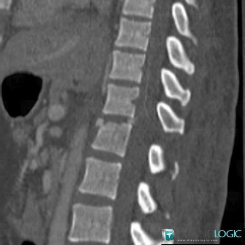 Vertebral fracture, Vertebral body / Disk, CT