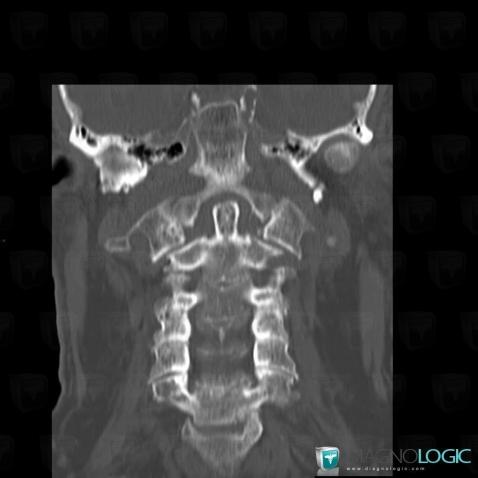 Vertebral fracture, Vertebral body / Disk, CT