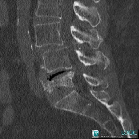 Radiology case : Vertebral fracture (CT ,MRI) - Diagnologic