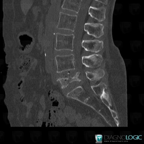 Vertebral fracture, Vertebral body / Disk, CT