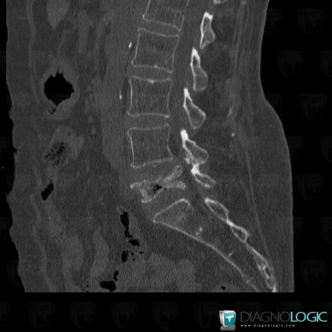 Vertebral fracture, Vertebral body / Disk, CT