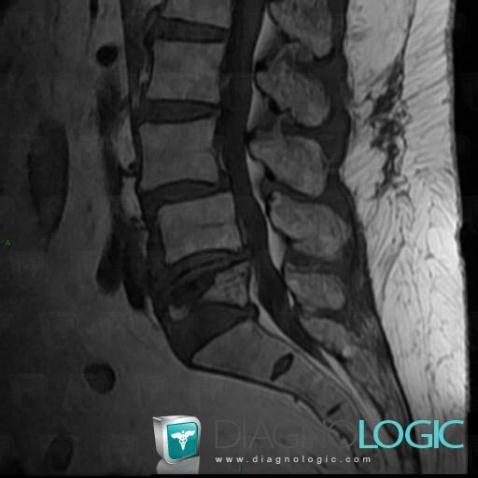 Vertebral fracture, Vertebral body / Disk, MRI