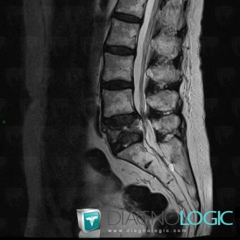 Vertebral fracture, Vertebral body / Disk, MRI