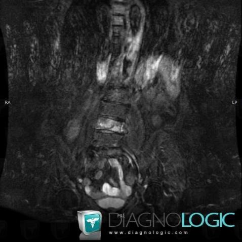 Vertebral fracture, Vertebral body / Disk, MRI