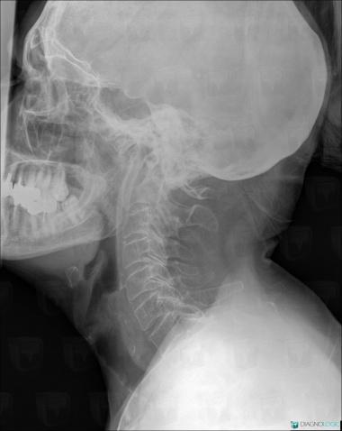 Vertebral fracture, Vertebral body / Disk, X rays