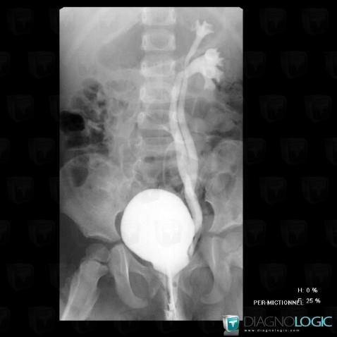 Vesicoureteral reflux, Collecting system, Ureter, X rays