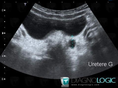 Vesicoureteral reflux, Ureter, US