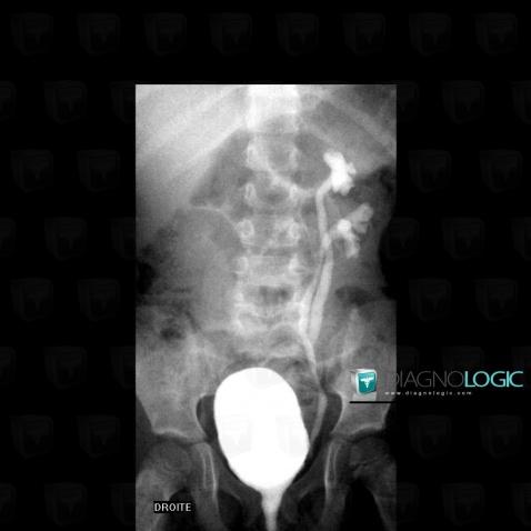 Vesicoureteral reflux, Ureter, X rays