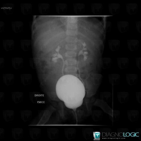 Vesicoureteral reflux, Ureter, X rays