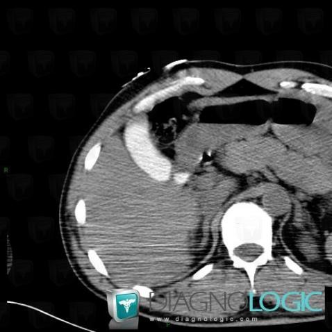 Vicarious contrast material excretion, Gallbladder, CT