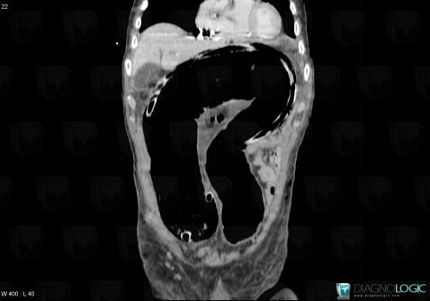 Volvulus-sigmoïde, Colon, Scanner