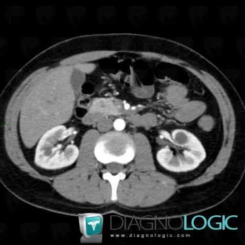 Von Hippel-Lindau syndrome, Kidney, CT