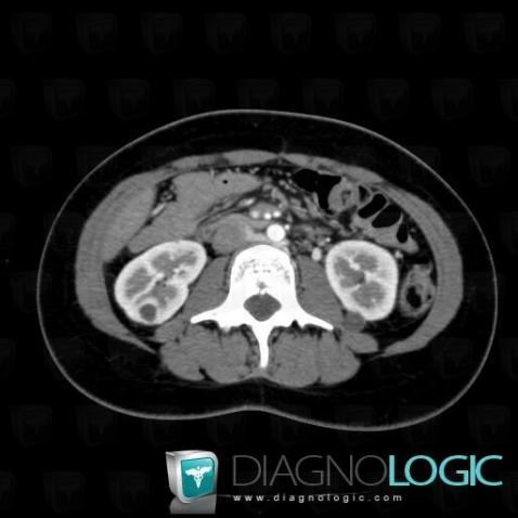 Von Hippel-Lindau syndrome, Kidney, CT