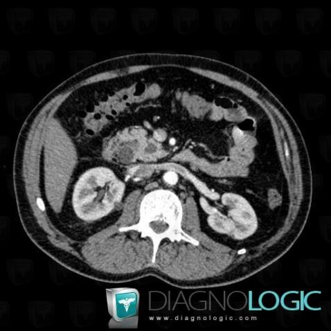 Von Hippel-Lindau syndrome, Pancreas, CT