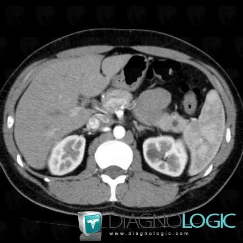 Von Hippel-Lindau syndrome, Pancreas, CT